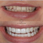 Is Teeth Whitening Wimbledon Worth It? A Consultant Explains Results dentist in Wimbledon